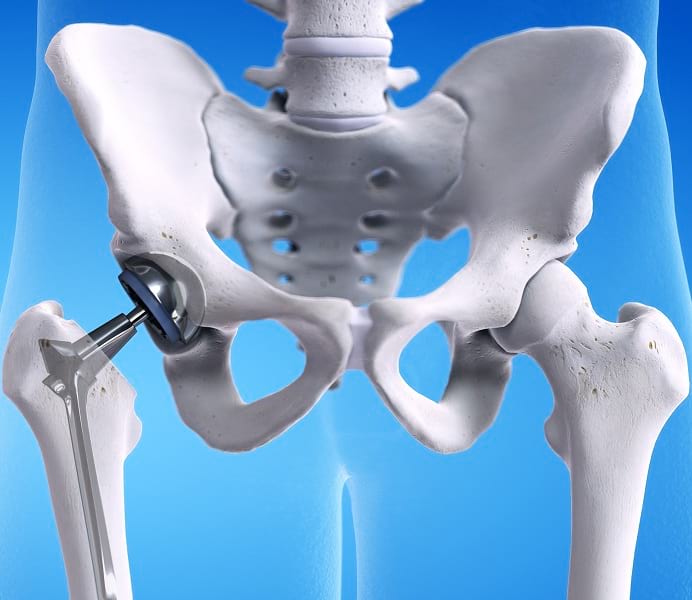 hip replacement